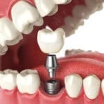 dental implants dentist