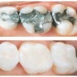 white fillings