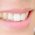 teeth whitening