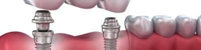 Tooth implants
