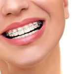 Ceramic Braces