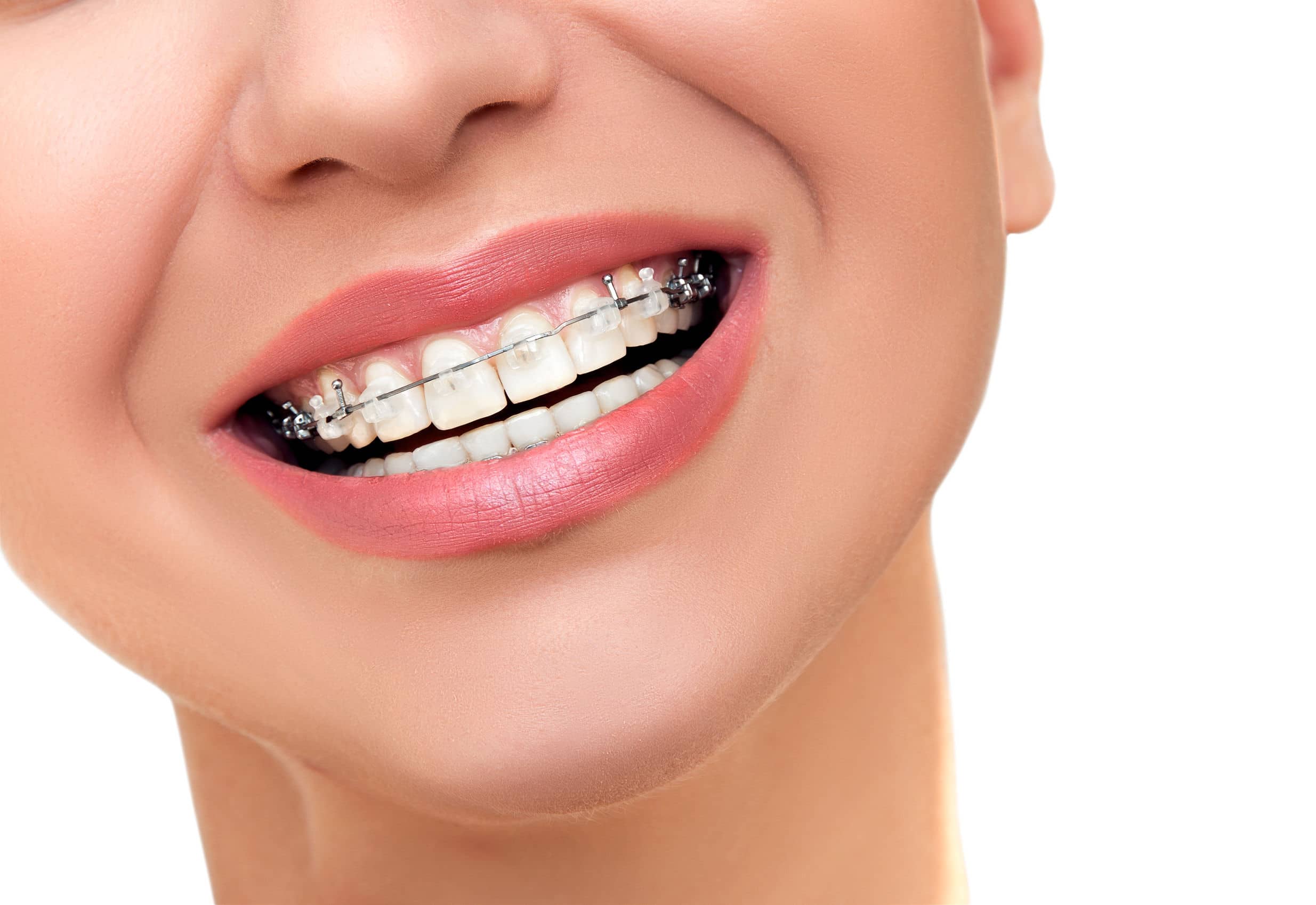 Ceramic Braces