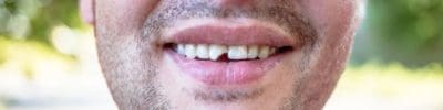 Chipped Tooth