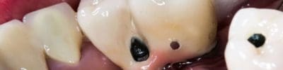 bone graft